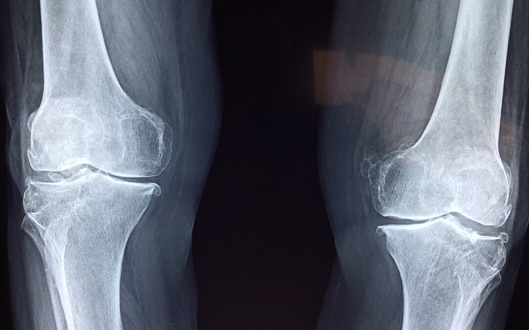 Say Goodbye to Knee Pain with a Non-Surgical Option